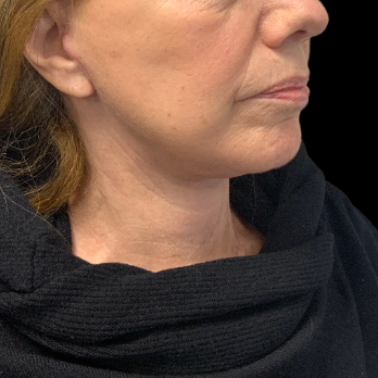 necklift-after